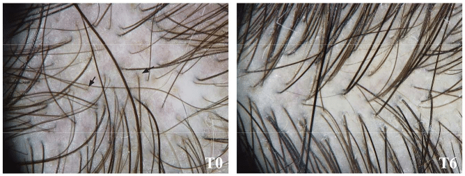 huile de nigelle cheveux